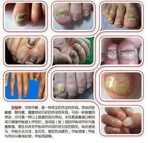 中国工厂网 美妆日化工厂网 美甲工具用品 洗甲水 灰指甲的正规治疗